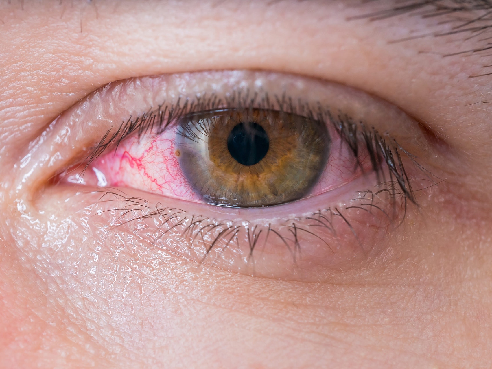 На зображенні крупним планом показано хворе око, що ілюструє появу потенційних ризиків для очей. 